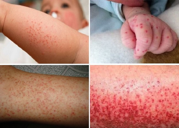 Tăng cường thực hiện các biện pháp phòng chống dịch Sốt xuất huyết trên địa bàn huyện trong mùa mưa
